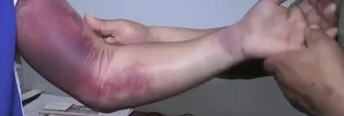 Joven denuncia haber sufrido brutal golpiza por Carabineros bajo toque de queda en Chiguayante