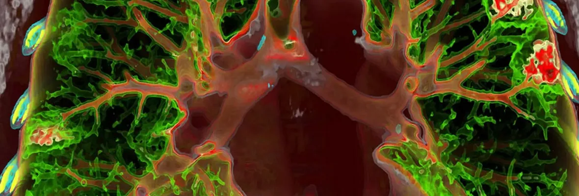 Primer estudio a gran escala evalúa factores de riesgo en deterioro de la función pulmonar de pacientes convalecientes de Covid-19