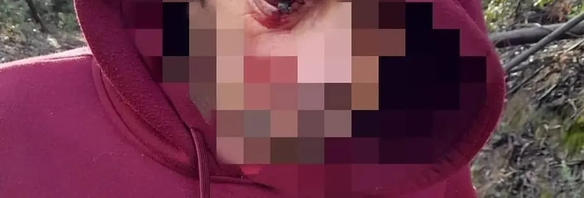 Comunero herido con trauma ocular por perdigones de Carabineros continúa sin atención médica en Lov Vilo, comuna de Arauco