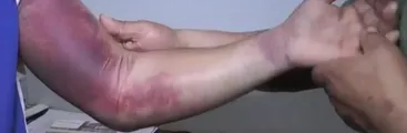 Joven denuncia haber sufrido brutal golpiza por Carabineros bajo toque de queda en Chiguayante
