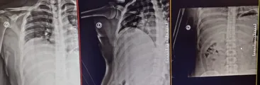 Hemorragia y costilla fracturada: Gendarmes golpearon brutalmente a preso político del Estallido Social en Cárcel de Puente Alto