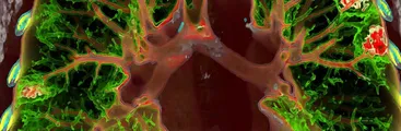 Primer estudio a gran escala evalúa factores de riesgo en deterioro de la función pulmonar de pacientes convalecientes de Covid-19